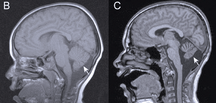 Brain scans show atrophy of the cerebellum in a boy with Christianson syndrome. Researchers observed this symptom in several boys with the autism-like condition. (Credit: Eric Morrow)