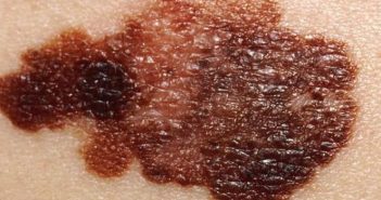 A new study finds that melanoma screening by primary care providers did not lead to a spike in dermatologist visits or skin surgeries. Photo courtesy Wikimedia Commons/National Cancer Institute