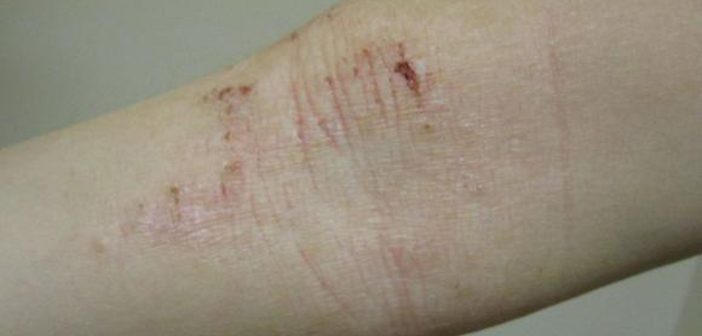 Despite mixed evidence recently about an association between atopic dermatitis and cardiovascular disease, a new study that analyzed more than 250,000 medical records suggests there is no link. Wikimedia Commons photo