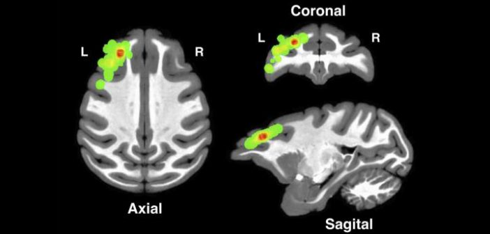 Brain images from different angles show locations in the dorsolateral prefrontal cortex where researchers made their measurements. Courtesy Asaad et al.