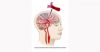 The rate of strokes, particularly ischemic strokes in which blood flow is blocked by clots or clogged arteries, appears to be dropping faster in men than in women. Courtesy NIH