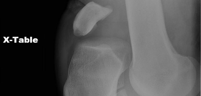 A patient x-ray shows a particularly severe knee dislocation. Courtesy Johnson