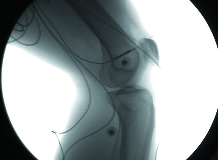 INSIDE LOOK: A video x-ray shows the position and subtle motions of a human healthy knee during landing from a one-leg hop. The visible wires and radio-opaque spheres are part of skin mounted biomechanics equipment that synchronize with the XROMM measurements. Image courtesy Braden Fleming