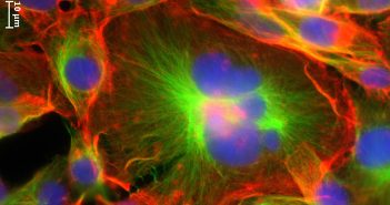 Giant cancer cells surrounded by other, smaller cancer cells. “The giant cancer cells break all the cancer rules," study co-author Michelle Dawson says. Photo courtesy Dawson Lab